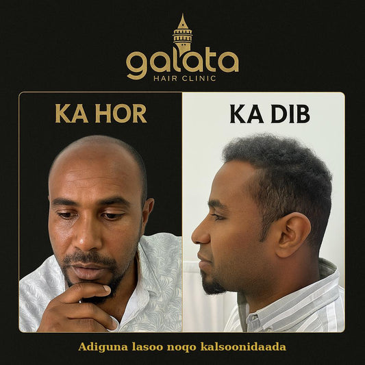 Qalliinka(Beerista) Timaha: Xalka Joogtada ah ee Bidaarta