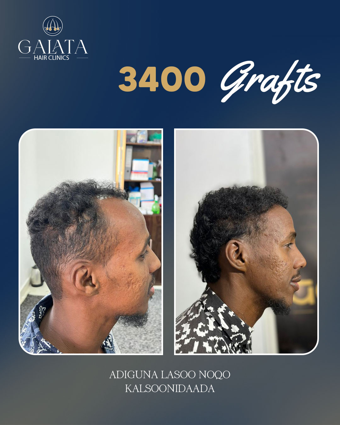After hair transplant